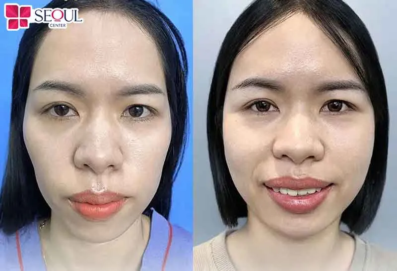 Cấy mỡ thái dương giúp gương mặt cân đối, hài hòa, nâng cấp diện mạo trẻ trung, duy trì kết quả dài lâu