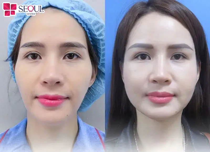 Phương pháp này lấp đầy hoàn toàn những vùng lõm hóp kém cân xứng trên gương mặt, trả lại diện mạo tươi tắn, xinh xắn, hài hòa cho khách hàng