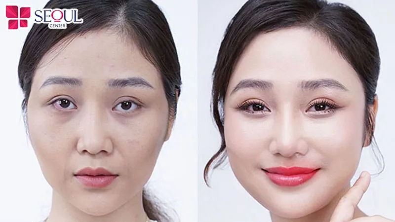 Cấy mỡ toàn mặt duy trì hiệu quả khá lâu dài cho khách hàng