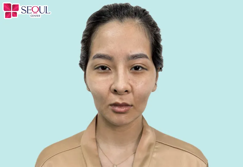 Những ai bị lõm hóp nhiều vùng trên mặt như chị khách này nên cấy mỡ toàn mặt để khắc phục