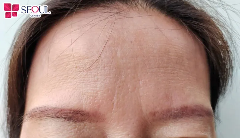 Cấy mỡ trán phù hợp với những ai gặp phải tình trạng trán nhăn sâu, hóp, lõm, ngắn