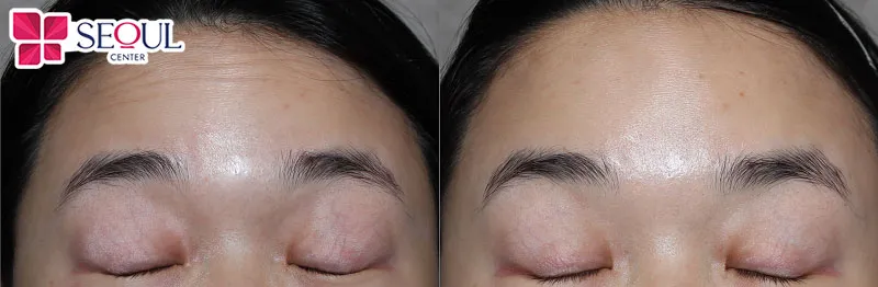 Chi phí cấy mỡ trán tại Seoul Center là 20 triệu, mức giá này khá phải chăng, xứng đáng với kết quả mà khách hàng nhận được