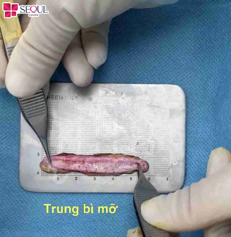 Phần trung bì mỡ này sẽ giúp khắc phục tình trạng lộ sóng, bóng đỏ đầu mũi