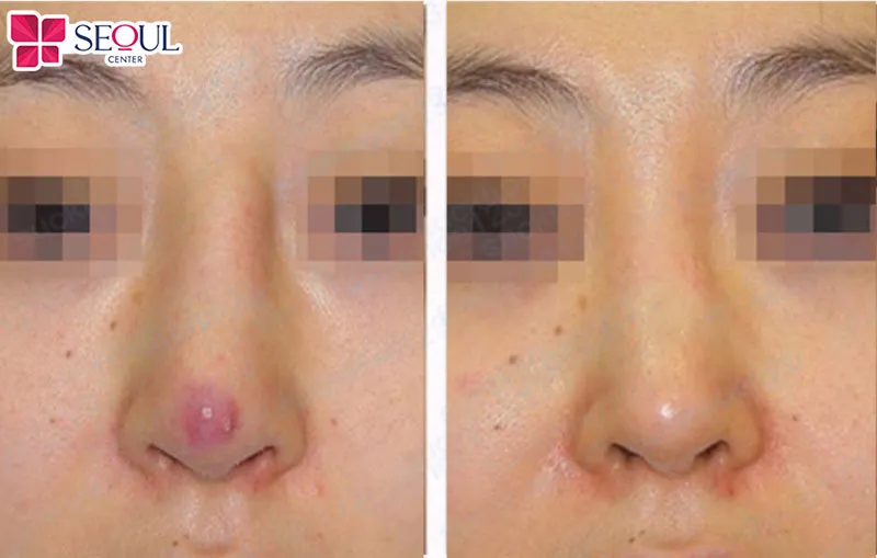 Cấy mỡ trung bì mũi giúp khắc phục triệt để tình trạng bóng đỏ, lộ sóng mũi