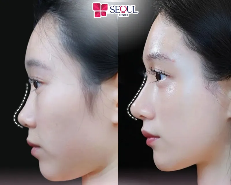 Cấy mỡ trung bì mũi không chỉ giúp tạo dáng mũi tự nhiên, mà còn cải thiện làn da