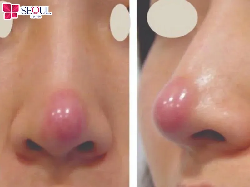 Những ai gặp tình trạng đầu mũi bóng đỏ sau nâng mũi có thể áp dụng cách cấy mỡ trung bì mũi để khắc phục