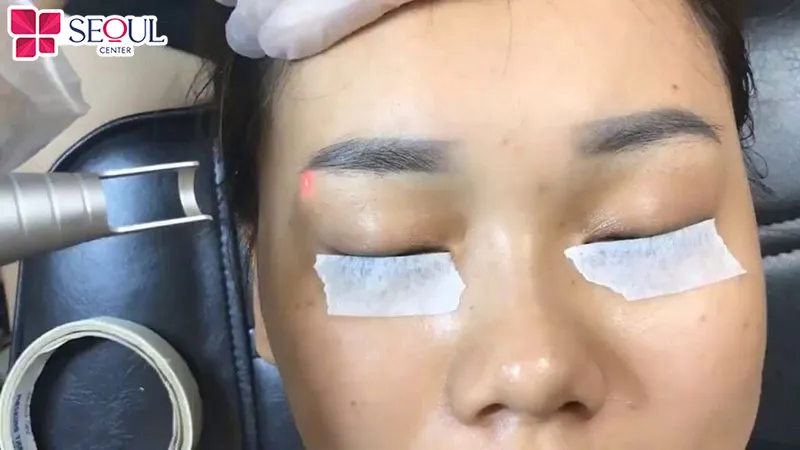 Bác sĩ tiến hành xóa hoàn toàn lớp mực cũ