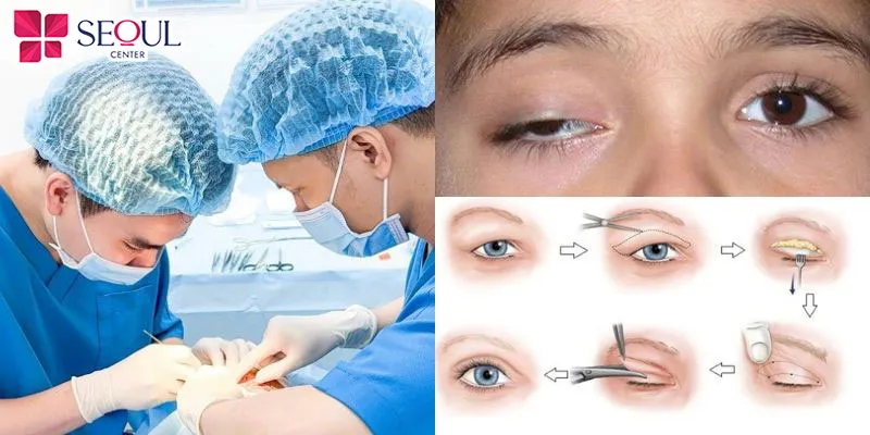 Chỉnh sụp cơ mí bẩm sinh là phương pháp can thiệp vào cấu trúc cơ nâng mi bị yếu, kém phát triển nhằm phục hồi chức năng thị giác ngăn ngừa nhược thị