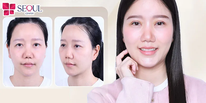 Chỉnh sụp cơ mí bẩm sinh không chỉ tạo mí đẹp hài hòa mà còn cải thiện thị lực và tầm nhìn cho khách hàng