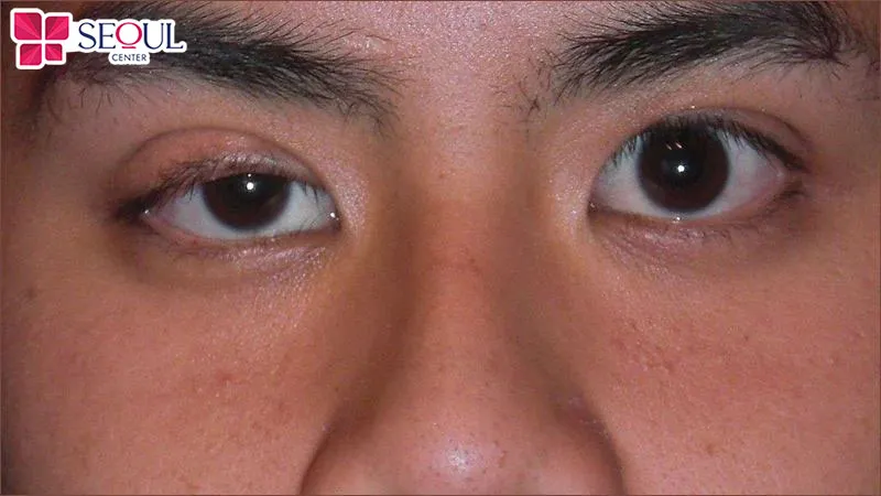 Tình trạng khách hàng bị sụp mí bẩm sinh nên sử dụng dịch vụ này để khắc phục