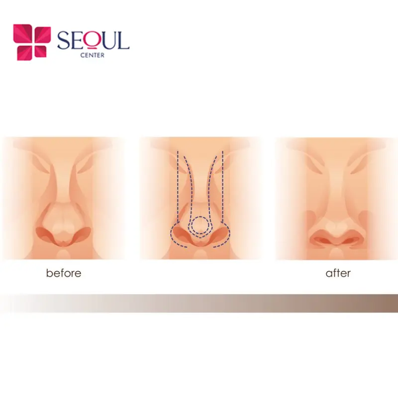 Chỉnh xương gồ bè là phương pháp gọt/cắt bỏ phần xương nhô lên ở sống mũi và thu gọn phần xương hai bên cánh tạo dáng mũi cân đối, hài hòa thon gọn