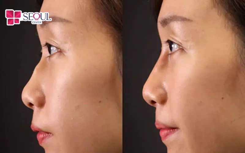 Phương pháp chỉnh xương gồ bè giúp tạo dáng mũi thanh tú, tỷ lệ vàng