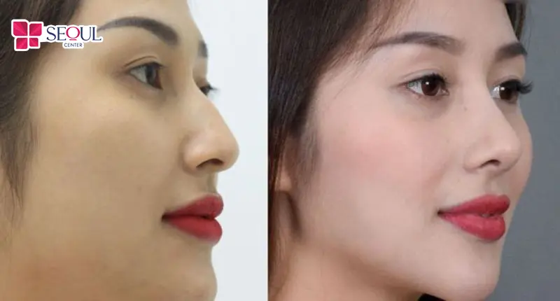 Mũi sau khi chỉnh xương gồ bè có thể duy trì kết quả vĩnh viễn