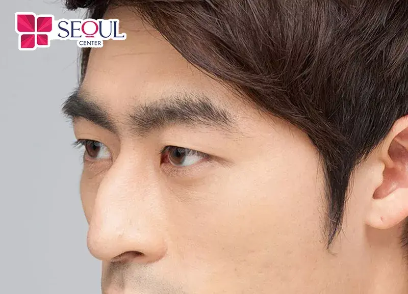 Những ai có tình trạng mũi gồ bè gây ảnh hưởng diện mạo có thể khắc phục bằng phương pháp chỉnh xương gồ bè