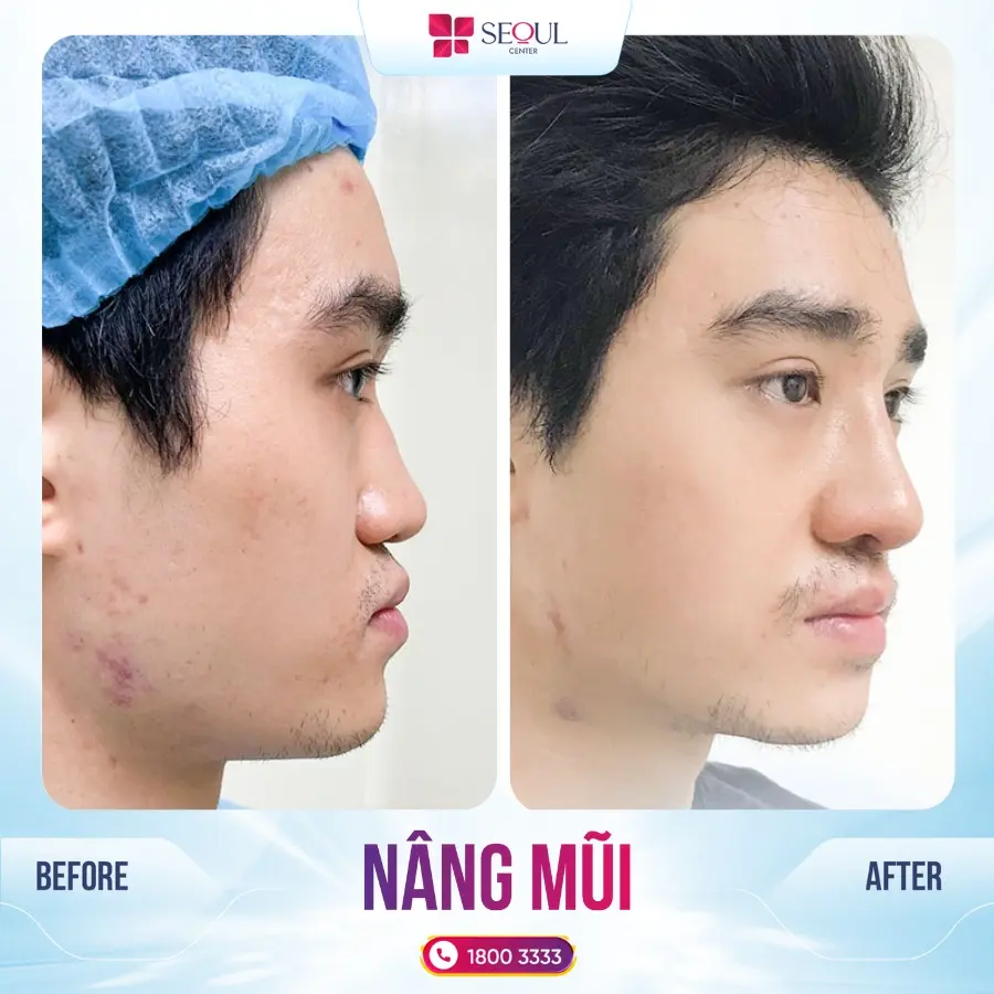 Hình ảnh khách hàng trước và sau chỉnh xương gồ bè kết hợp nâng mũi tại Thẩm mỹ viện Seoul Center