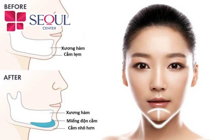 Độn cằm Nanoform giúp tạo dáng cằm đẹp, duy trì kết quả dài lâu