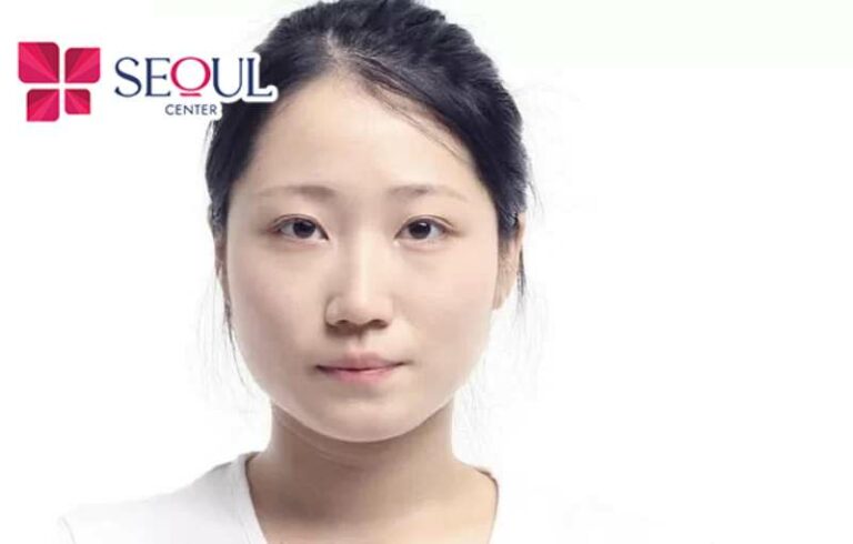 Những khách hàng có cằm ngắn, cằm lẹm, gương mặt thô, vuông rất thích hợp độn cằm Nanoform