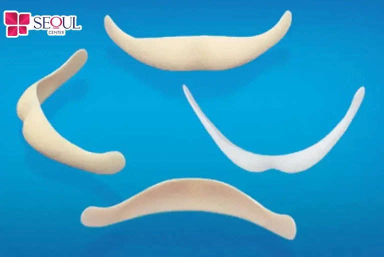 Sụn Surgiform sở hữu nhiều ưu điểm vượt trội như độ tương thích cao, khả năng chịu lực tốt, độ bền vĩnh viễn