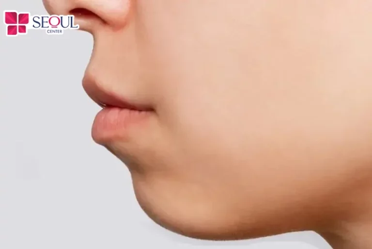 Những người có cằm lẹm, cằm ngắn, da cằm mỏng muốn tạo dáng cằm Vline có thể chọn độn cằm Surgiform