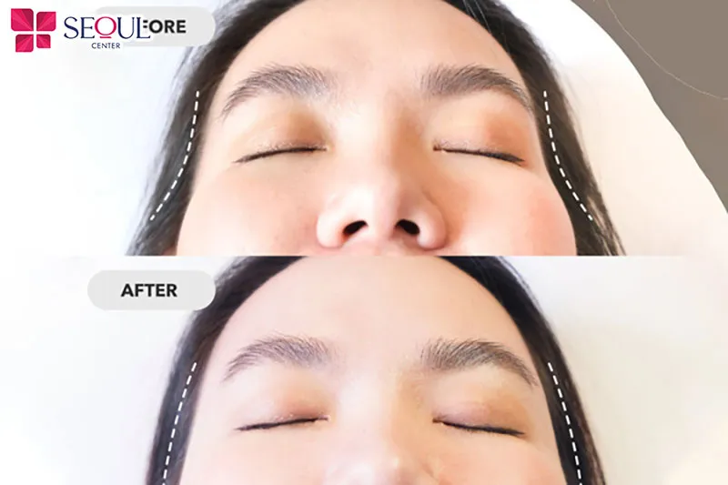 Độn thái dương Nanoform giúp lấp đầy thái dương, mang lại gương mặt hài hòa