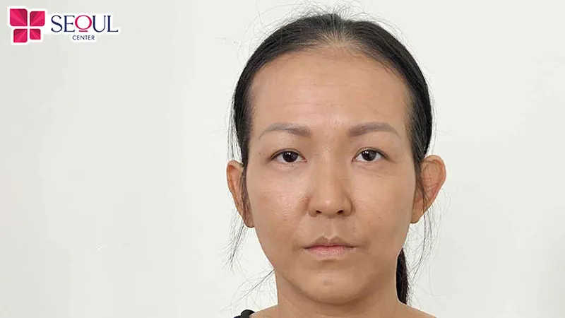 Những ai có thái dương lẹm, hóp có thể áp dụng phương pháp độn thái dương Nanoform để khắc phục