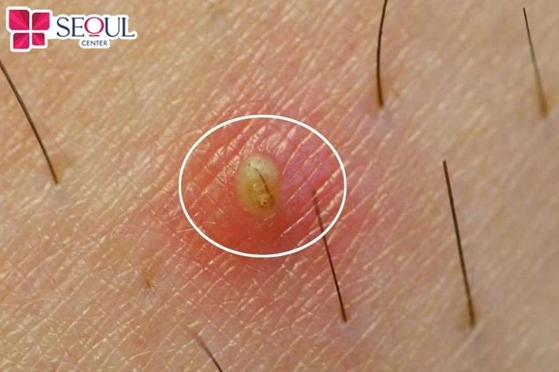 Khi vùng bikini có mụn nhọt, vết thương hở, vết xước mẹ bầu không nên tẩy lông