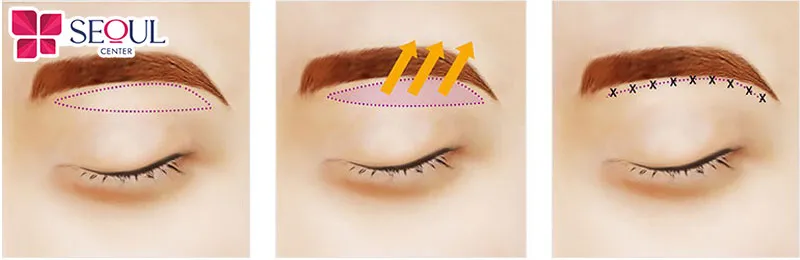 Nâng cung chân mày Perfect còn gọi là treo chân mày giúp khắc phục tình trạng da chùng, chảy xệ vùng chân mày mí mắt, mang lại diện mạo tươi trẻ