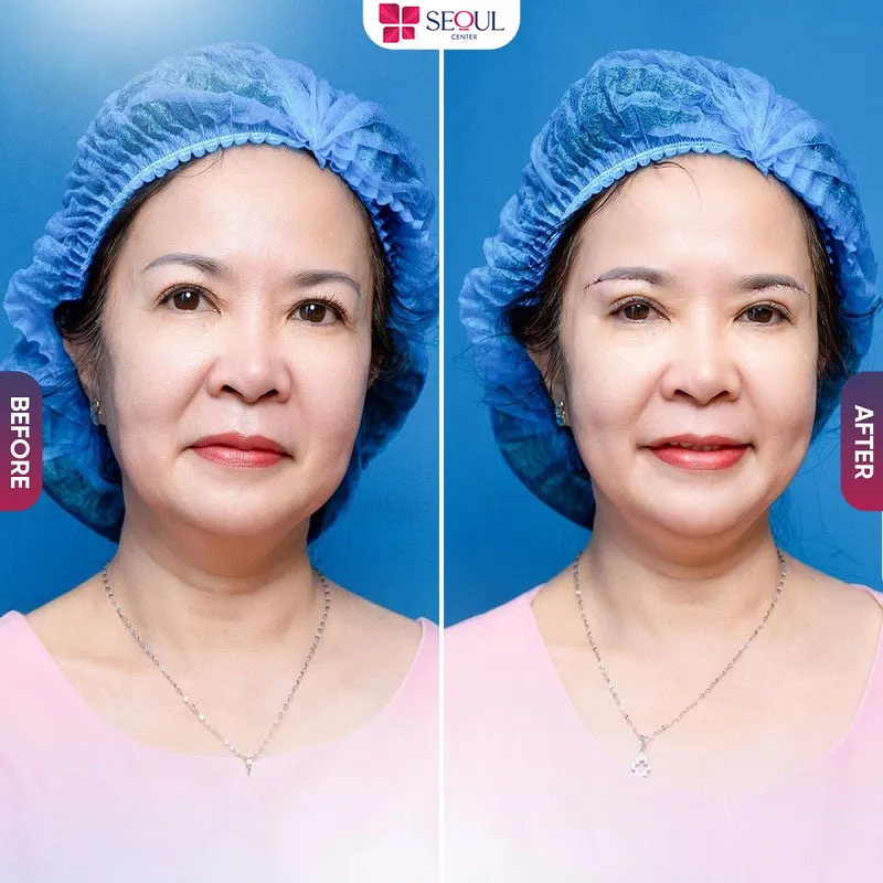 Chân mày cao và gọn hơn,, diện mạo khách hàng trẻ trung hơn sau khi thực hiện nâng cung mày tại Seoul Center