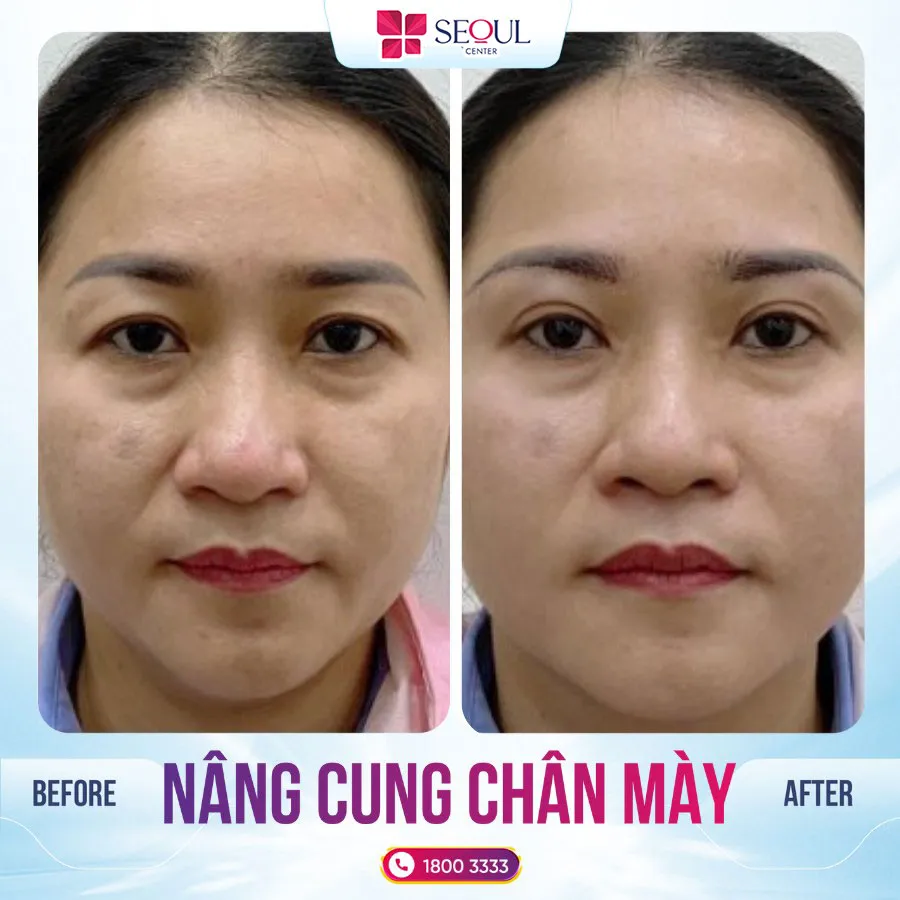 Feedback khách hàng sau khi treo cung chân mày tại Seoul Center