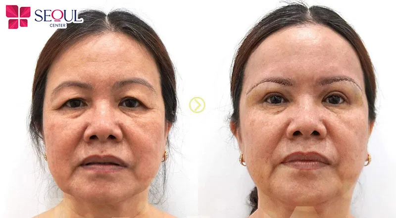 Nâng cung chân mày Perfect giúp khắc phục hoàn toàn tình trạng sụp mí, da chùng quanh vùng chân mày