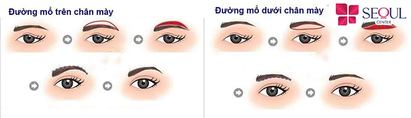 Kỹ thuật nâng cung chân mày Perfect giúp giấu vết khâu khéo léo, không để lại sẹo xấu