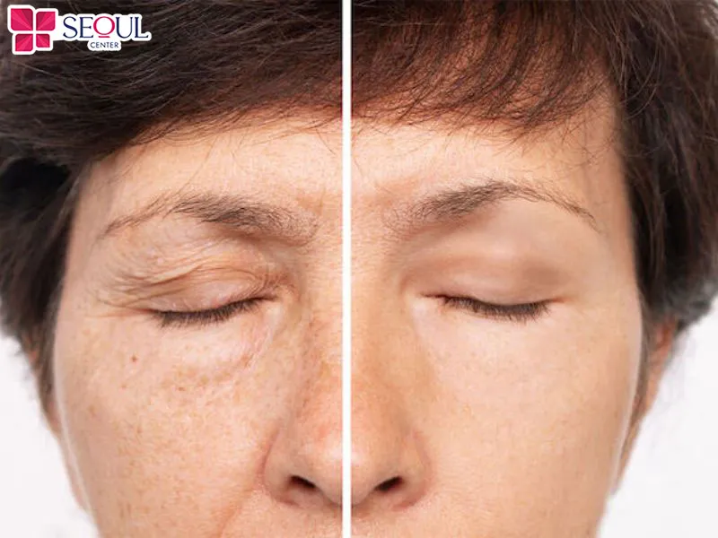 Khách hàng bị sụp chân mày, phần mí trên chùng nhão, chảy xệ