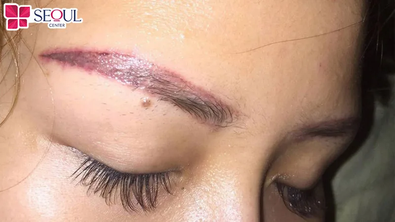 Chân mày bị sưng đỏ, lở loét là dấu hiệu bị nhiễm trùng sau khi phun xăm