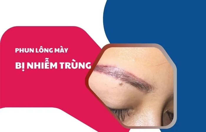 Phun lông mày bị nhiễm trùng