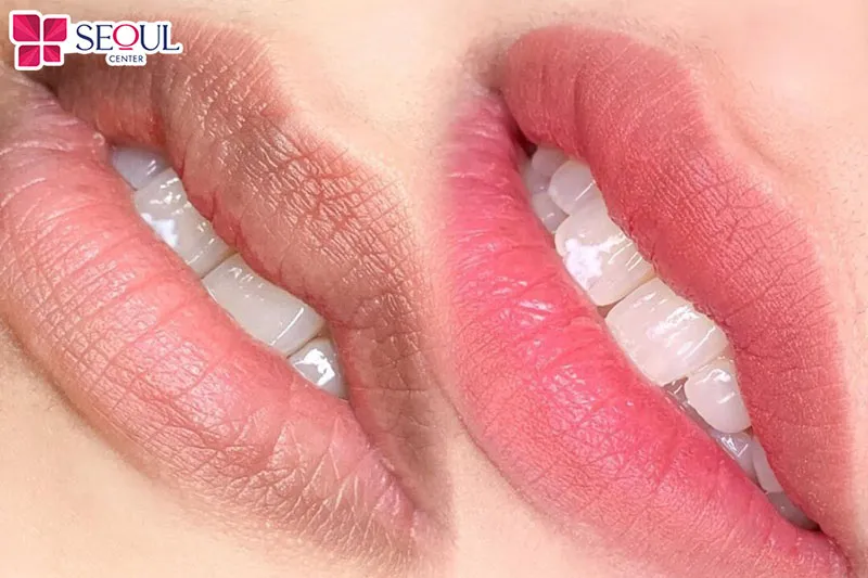 Phun môi màu hồng san hô duy trì được 3 - 5 năm, phụ thuộc vào nhiều yếu tố