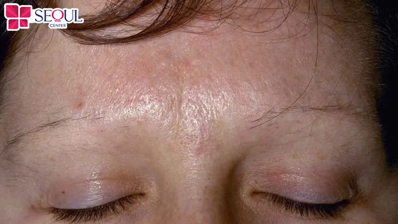 Lông mày bị rụng có thể do các bệnh lý về da gây nên