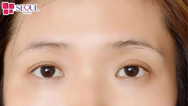 Lông mày bị rụng vẫn có thể mọc lại bình thường