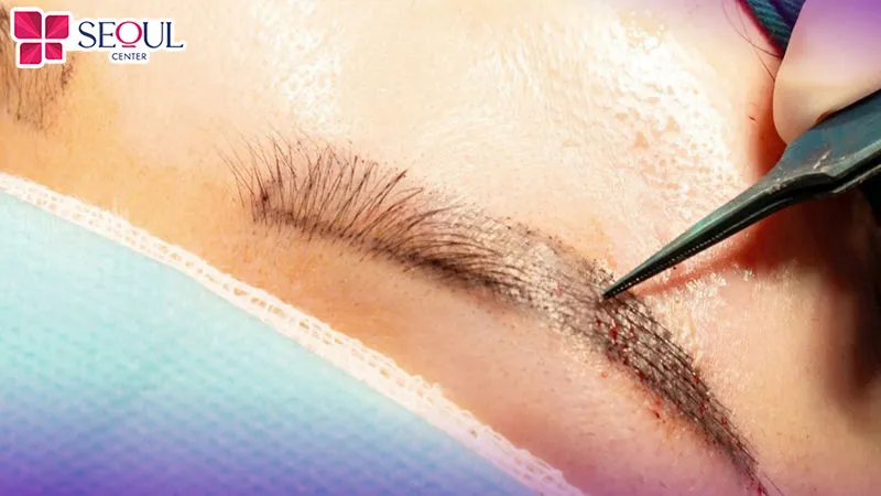 Cấy ghép giúp tái tạo và phát triển lông mày một cách tự nhiên