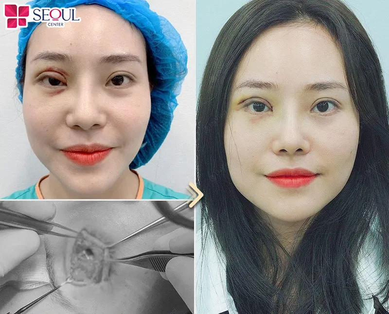 Sửa mí Perfect là giải pháp hoàn hảo để khắc phục hoàn toàn những lỗi mí hỏng trước đó