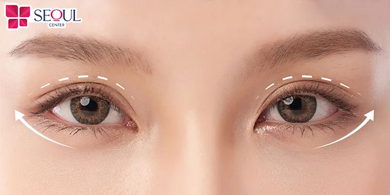 Sửa mí Perfect giúp tạo nếp mí tự nhiên, đôi mắt hài hòa, chuẩn tỷ lệ vàng