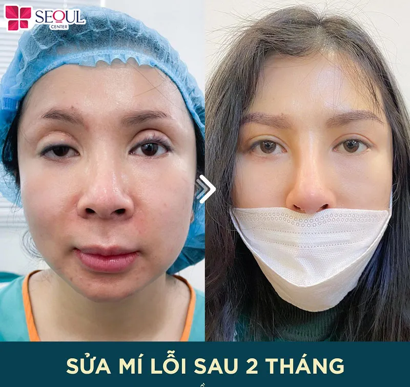 Sau khi sửa mí Perfect kết quả sẽ được duy trì lâu dài
