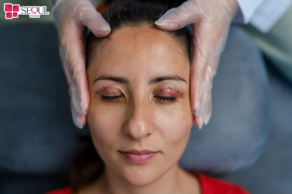 Sửa mí Perfect là dịch vụ phù hợp với những khách hàng có mí mắt bị hỏng do phẫu thuật