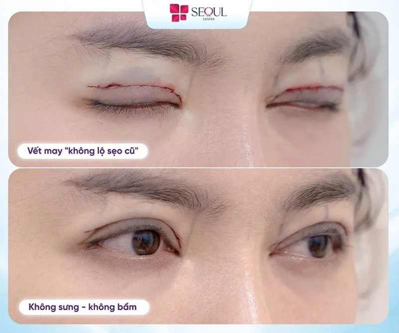 Dịch vụ sửa mí Perfect tại Seoul Center sẽ giúp khách hàng sửa mí đẹp, tự nhiên, không để lại sẹo cho khách hàng