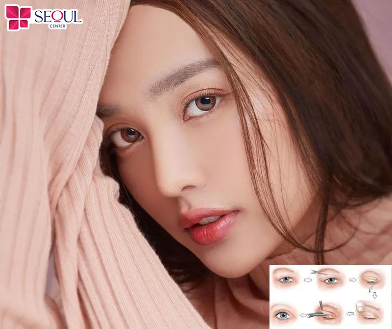 Sửa mí Phượng Hoàng giúp khắc phục lỗi mí cũ, tạo nếp mí mới đẹp thanh thoát tựa mí Phượng Hoàng