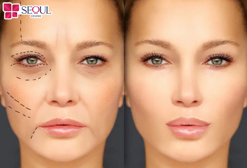 Sửa mí Phượng Hoàng giúp tạo nếp mí sắc sảo, chuẩn tỷ lệ vàng