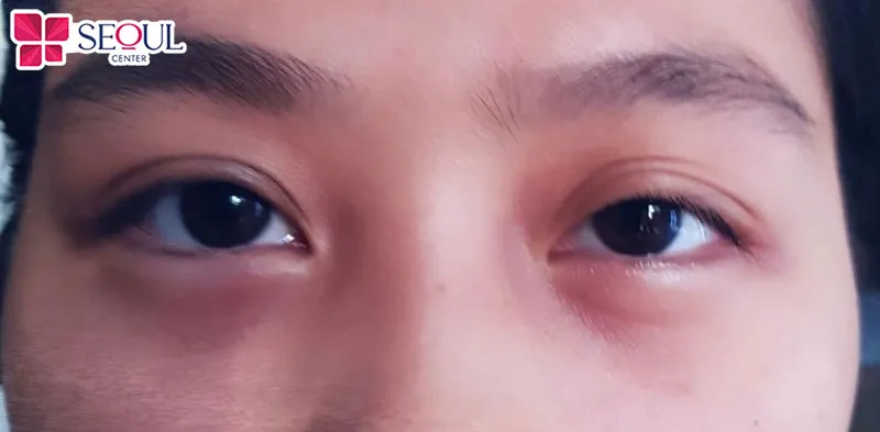 Những ai có mí hỏng, mí hai bên không cân xứng, sụp mí, đuôi mắt bị cụp, mí kém thẩm mỹ,...thì có thể chọn sửa mí Phượng Hoàng