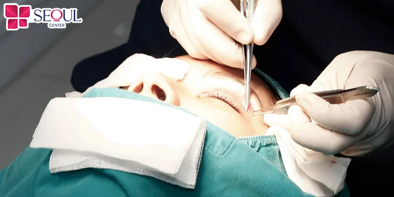 Kỹ thuật sửa mí tự nhiên khá phức tạp đòi hỏi bác sĩ thực hiện phải có tay nghề giỏi, trình độ chuyên môn và giàu kinh nghiệm