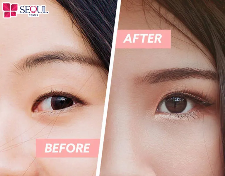 Dịch vụ sửa mí tự nhiên mang lại đôi mắt hai mí tựa như bẩm sinh