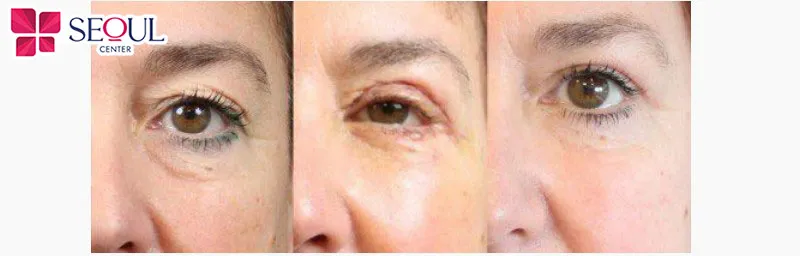 Những ai có mí hỏng do lần phẫu thuật trước và muốn khắc phục nhưng vẫn đảm bảo yếu tố tự nhiên thì hãy chọn dịch vụ sửa mí tự nhiên tại Seoul Center