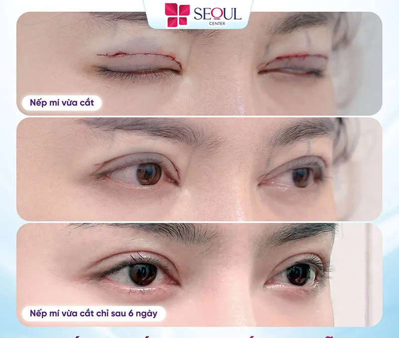 Hiệu quả trước và sau khi khách hàng sửa mí tự nhiên tại Thẩm mỹ viện Seoul Center